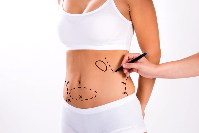 Abdominoplastia